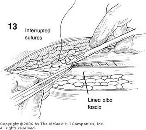 Zollinger Atlas Of Surgery Laparotomy The Closure