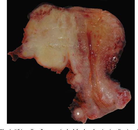 Figure 1 From Successful Treatment Of Squamous Cell Carcinoma Arising