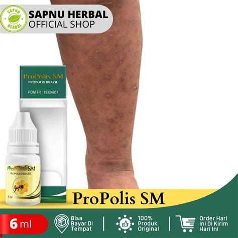 Jual Obat Penghilang Koreng Di Kaki Obat Darah Manis Salep Korengan