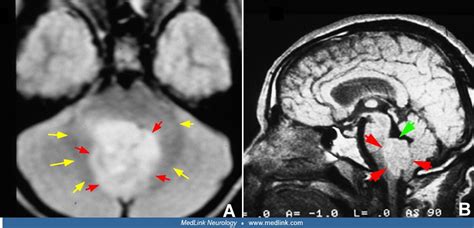 Ependymoma | MedLink Neurology