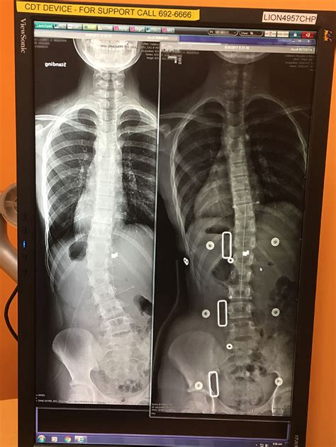 Scoliosis Brace Before And After