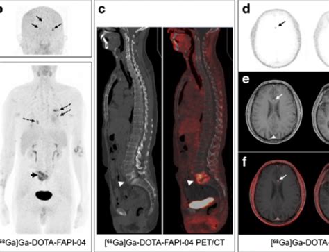 Fibroblast Activation Protein Targeted PET CT With 68 Ga FAPI For