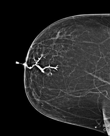 Intraductal Papilloma Radiology Case Radiopaedia Org