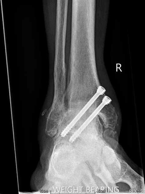 Total Ankle Replacement For Ankle Arthritis Nick Savva Consulting