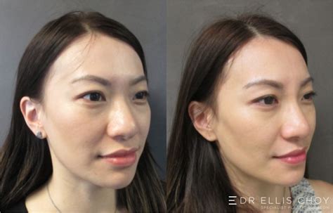 Asian Plastic Surgery Before And After Photos Seattle Bellevue E44