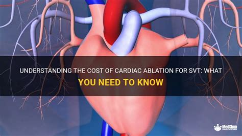 Understanding The Cost Of Cardiac Ablation For Svt What You Need To Know Medshun