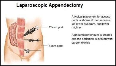 Appendix Removal Surgery Mumbai Laparoscopic Appendectomy India