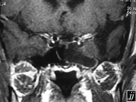 Sphenoidal Sinus Retention Cyst Radiopaedia