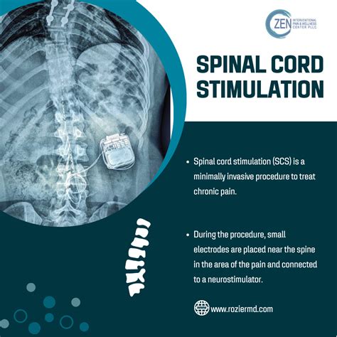 Benefits of Spinal Cord Stimulation: Patients Guide in Mansfield, Tx