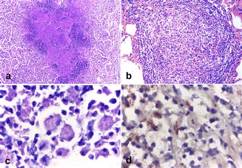 Microscopic Features Of Mycobacterium Tuberculosis Var Tuberculosis