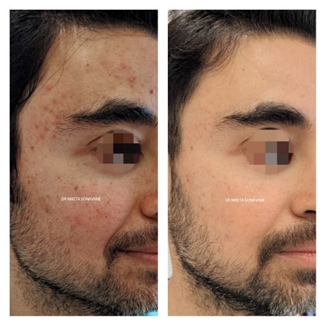 Collection 100 Pictures Deep Chemical Peel Before And After Photos Completed