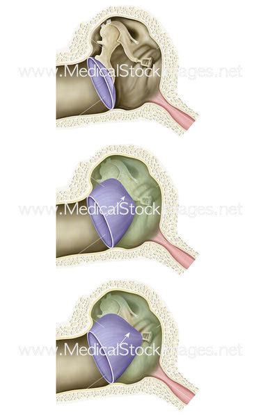 Tympanic Membrane Retraction Stages Middle Ear Atelectasis Medical Stock Images Company