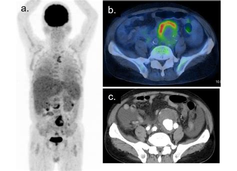 Ectopic Granuloma At The Abdominal Aortic Wall And Disseminated