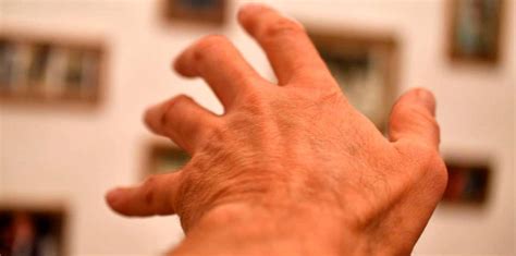 Lanzan Una Herramienta Con Ia Para El Cuidado De Pacientes Con Parkinson