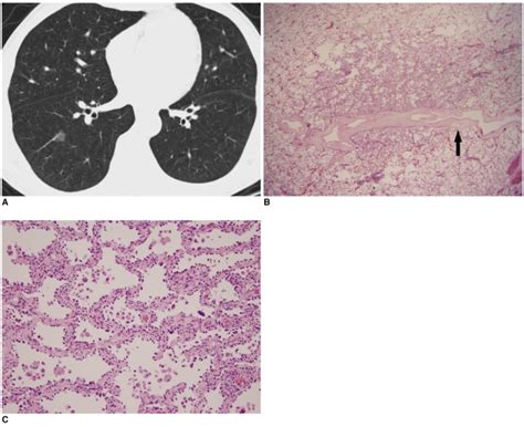 Ct Findings Of Atypical Adenomatous Hyperplasia In The Lung Pmc