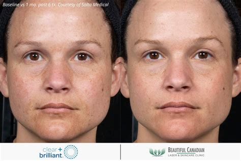 Clear Brilliant® Laser Skin Rejuvenation Vancouver Surrey