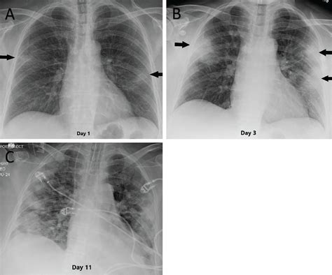 Thoracic Imaging In COVID 19 Cleveland Clinic Journal Of Medicine