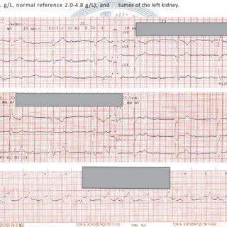 A Electrocardiography Ecg Of Our Patient On Admission In Er Note