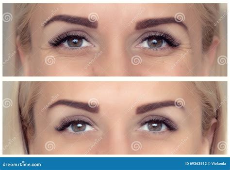 Injections Of Botox Before And After Stock Photo Image Of Medicine