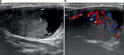 Thyroid Cyst Ultrasound