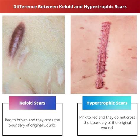 Keloidi Vs Hypertrofiset Arvet Ero Ja Vertailu