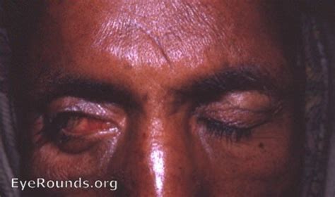 Keratitis e lagophthalmos with lateral tarsorraphy. EyeRounds.org ...