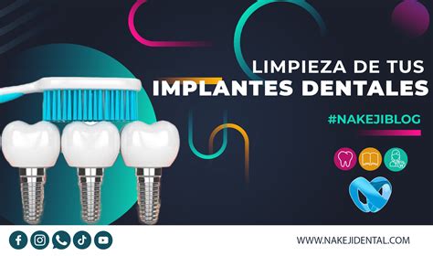 BLOG Cómo limpiar tus implantes dentales Clínica Dental Nakeji