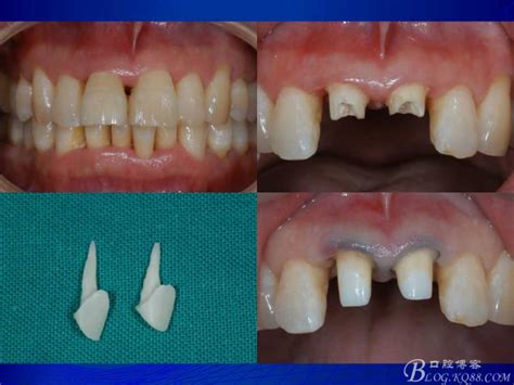 桩冠与桩核冠知识讲解（3）——常见桩核材料及根管桩操作过程 Lee筱筱的博客 Kq88口腔博客