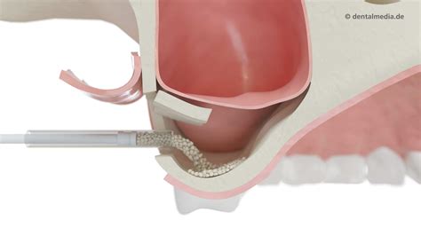 Knochenaufbau Augmentation Externer Interner Sinuslift