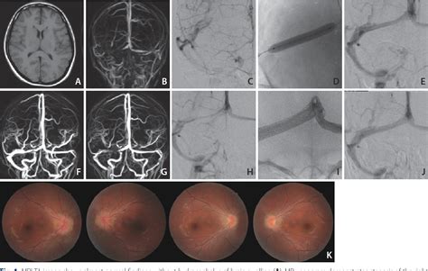 Figure 1 From Endovascular Treatment Of Idiopathic Intracranial