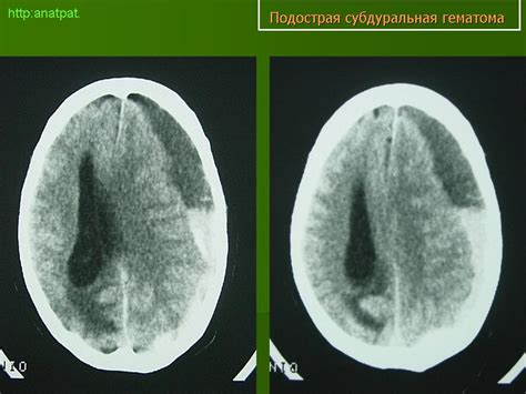ГМ. Гематомы. Субдуральная гематома (подострая). + | Портал радиологов