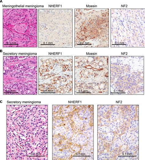 NHERF1 Moesin And NF2 Expression In WHO Grade I Meningioma A IHC