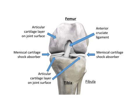 Knee arthritis - Knee Replacements in London