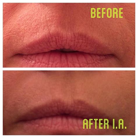 2 minute miracle on smokers lips Latina, Instantly Ageless, Lip Wrinkles, Life Changing ...