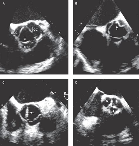 Aortic Valve Sclerosis and Aortic Valve Stenosis | Anesthesia Key