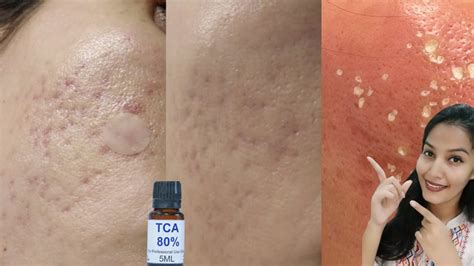 Tca Cross Results For Acne Scars Before After Care Remove Acne