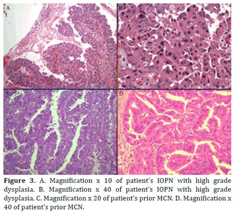 Intraductal Oncocytic Papillary Neoplasm Of The Pancreas A Case