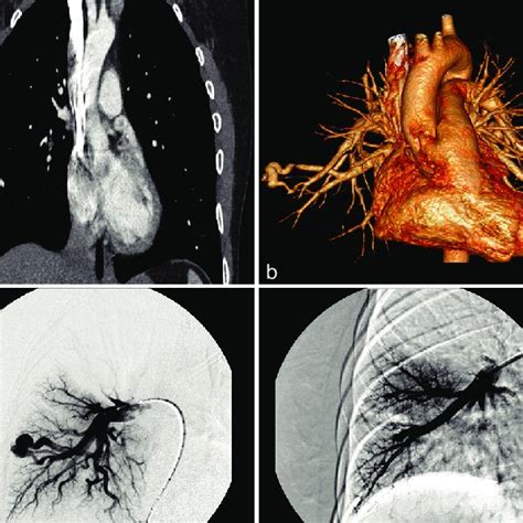 Right Lower Lobe Pulmonary Arteriovenous Malformations As Depicted At