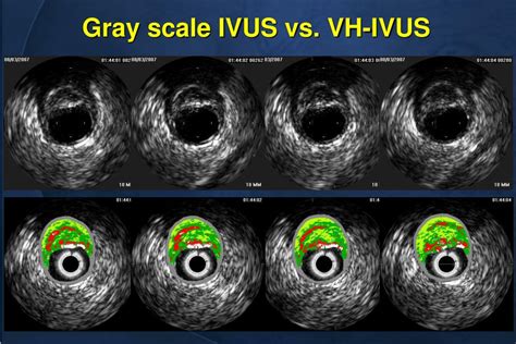 Ppt Ivus Vh Vulnerable Plaque Powerpoint Presentation Free