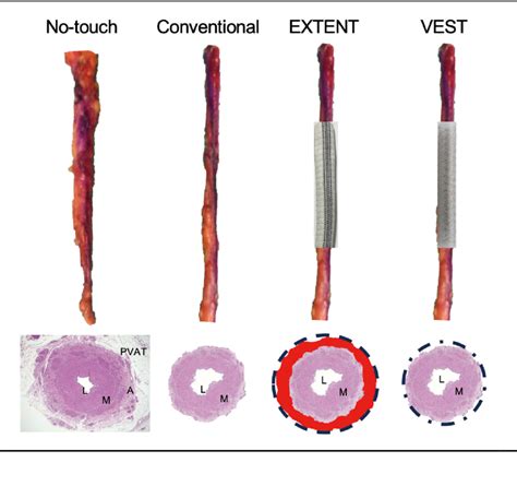 External Support Of Saphenous Vein Grafts Left To Right