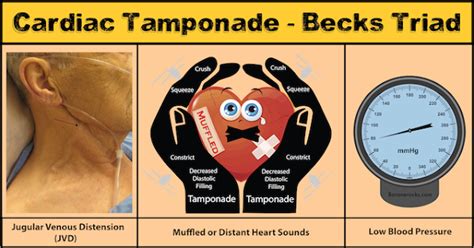 Beck's triad ~ MedstudCT