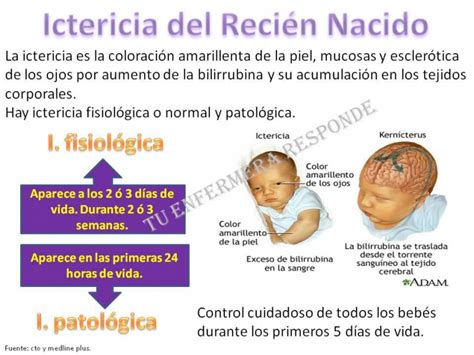 Ictericia Del ReciÃ©n Nacido