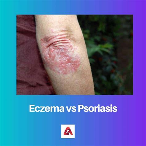 Eczema Vs Psoriasis Difference And Comparison