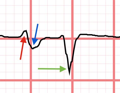 Lae Produces A Biphasic P Wave In V 1