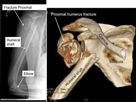 Proximal Humerus Fracture Boston Shoulder Institute