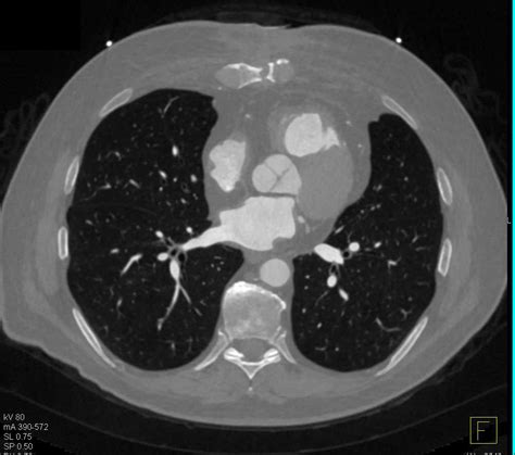 Sternal Osteomyelitis With Inflammation Musculoskeletal Case Studies