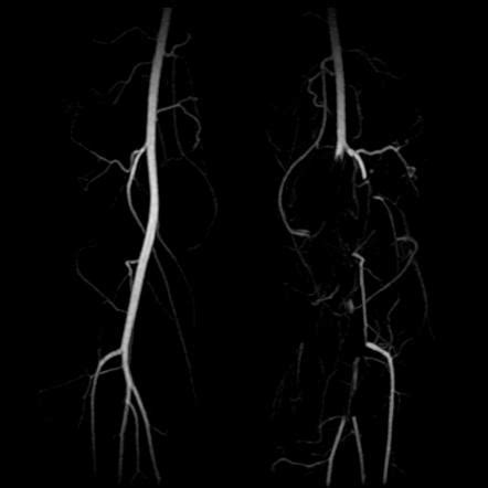 Popliteal Artery Entrapment Syndrome Radiology Reference Article