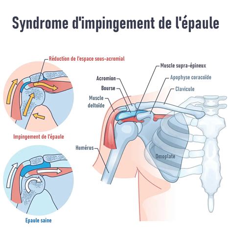 Sept exercices pour soulager le syndrôme dimpingement de lépaule