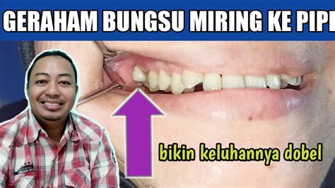 Geraham Bungsu Atas Sudah Miring Kepipi Berlubang Lagi Aduhaiiiii