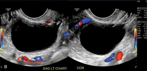 Ultrasound Of Common Adnexal Cysts Nbkomputer